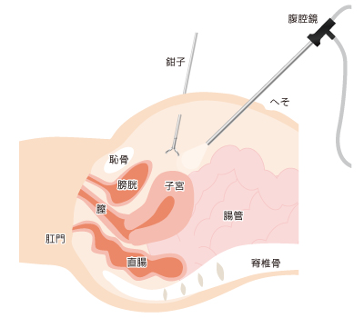 腹腔鏡手術の医療器具挿入経路