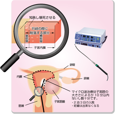 切らない治療MEA（マイクロ波子宮内膜アブレーション）