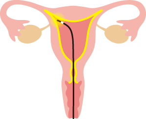 子宮腔の内面をすべて覆うようにマイクロ波を照射